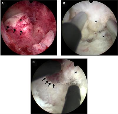 A Modified Technique of Bipolar Loop Resectoscopic Slicing for Treating Submucous Fibroids With Enucleation Makes the Operation Safer